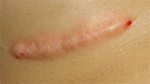 masaje en cicatriz
